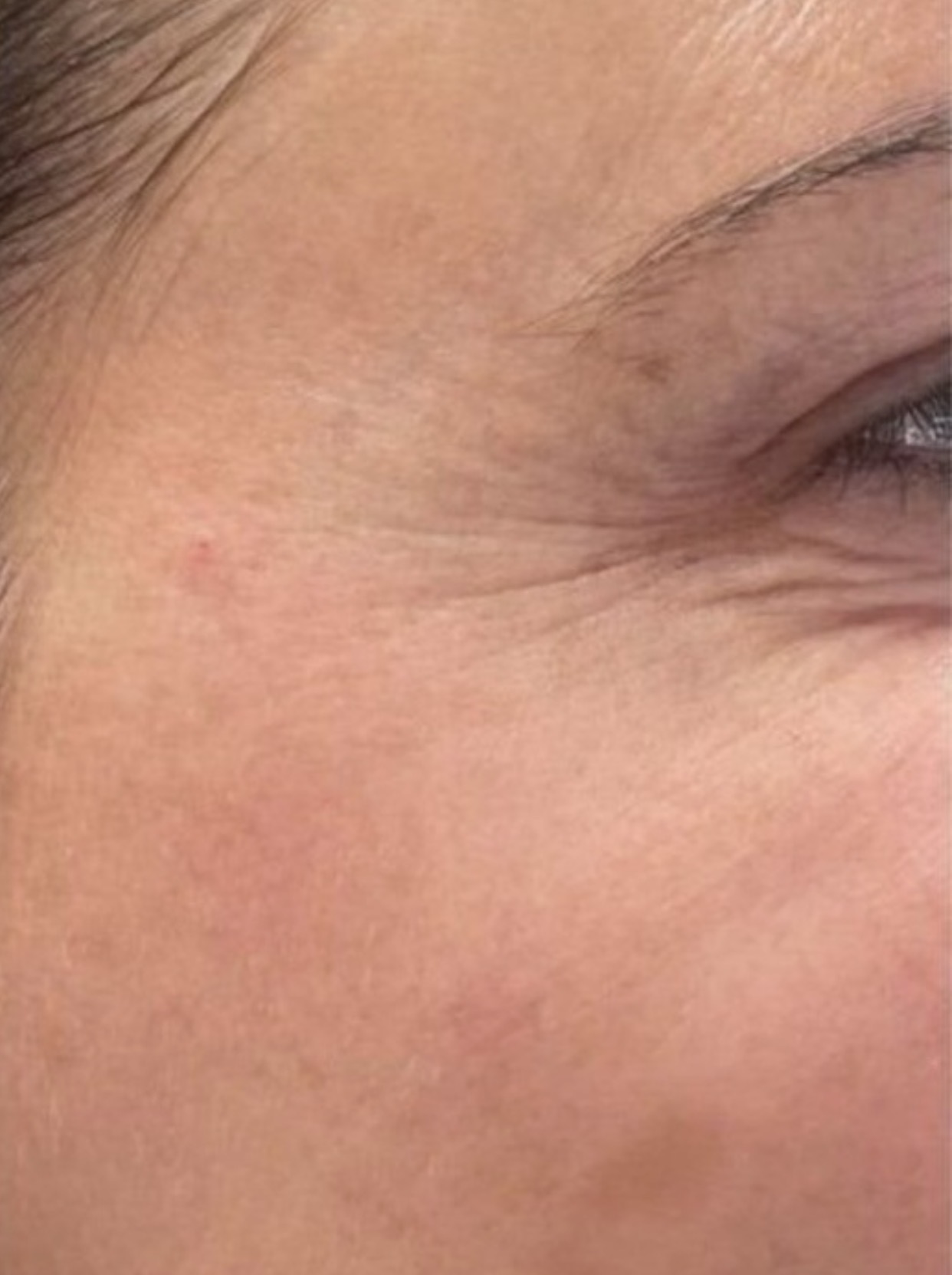 Después del tratamiento con toxina botulínica